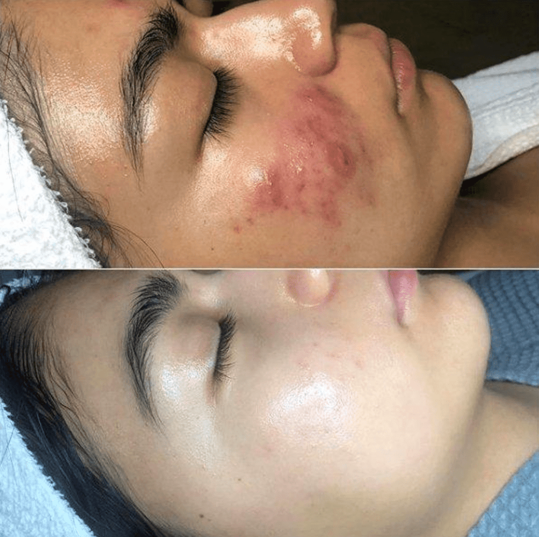 Skin therapy with high frequency - GlowWave