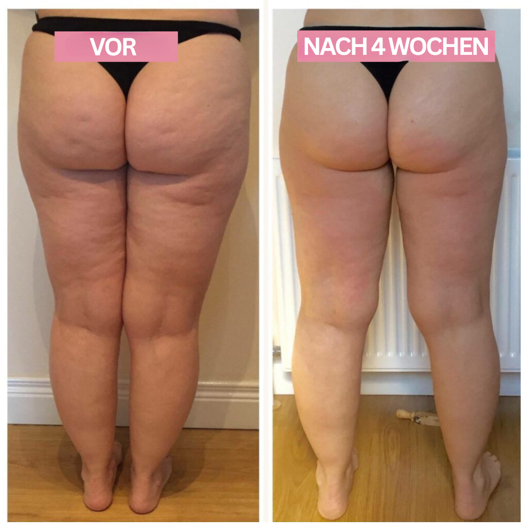 Anti-Cellulite-Cupping-Enhed – SlimCupp