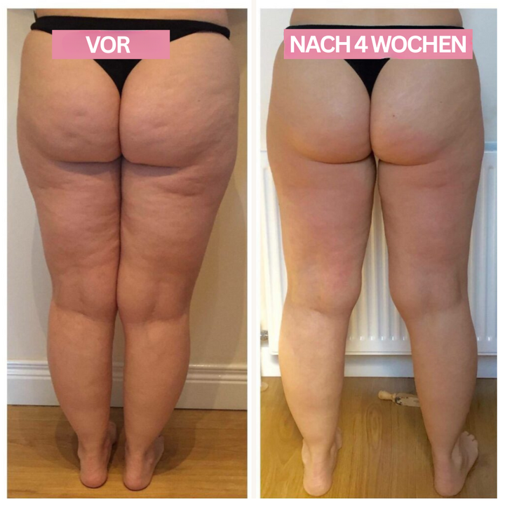 Anti-Cellulite-Cupping-Enhed – SlimCupp