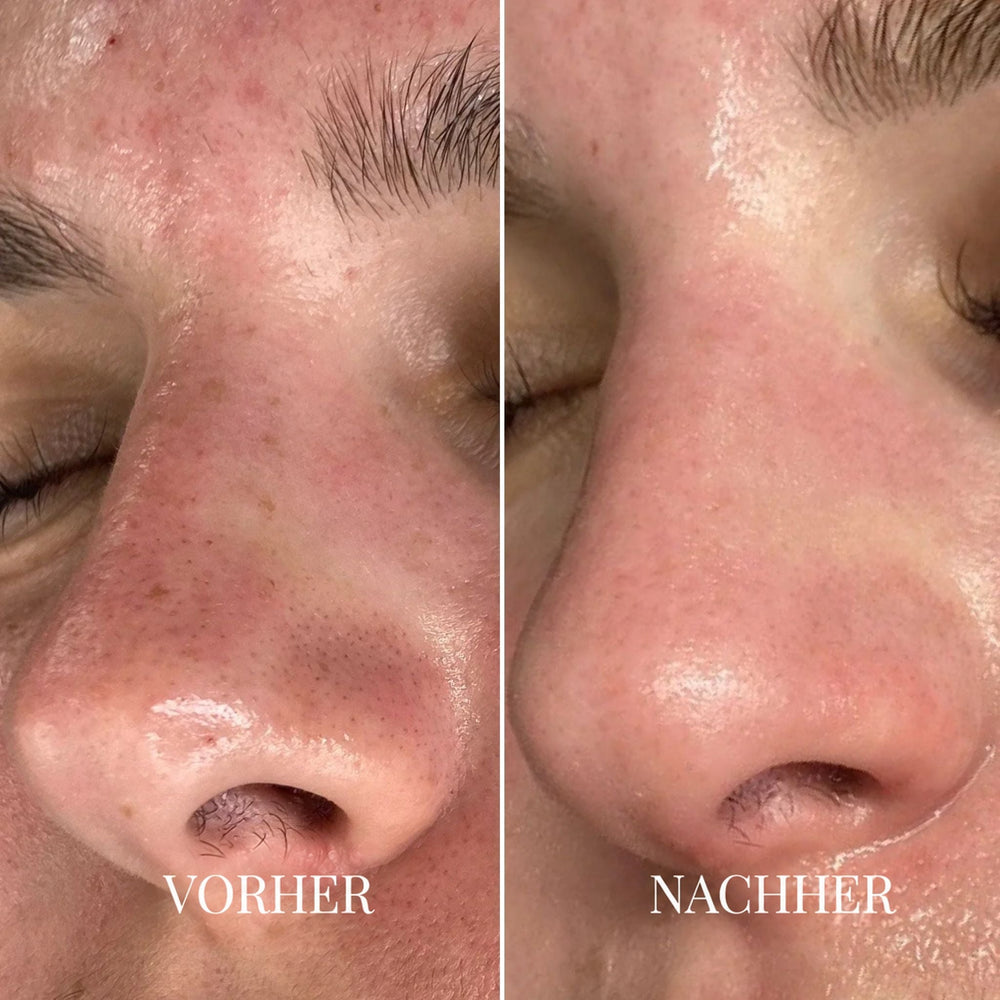 Vorher-Nachher-Vergleich einer Nase in Nahaufnahme: links mit sichtbaren Poren, rechts mit glatterer Haut 2